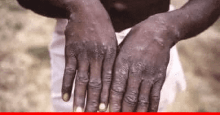 Mpox Outbreak in Kenya: Medics Urge Vigilance